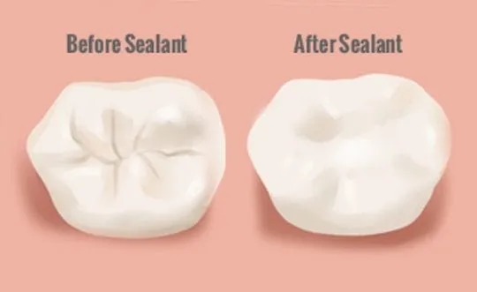 Dental Sealant